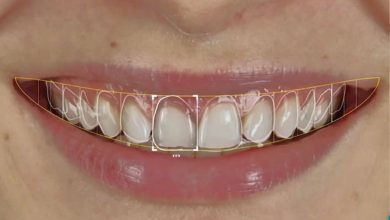 advanced-smile-design-technology:-precision-planning-for-guaranteed-results